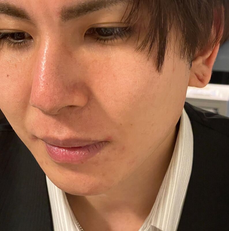 メンズ脱毛
